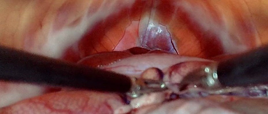 Endoscope view: the policy has closed the grasper on the appendix and lifts it